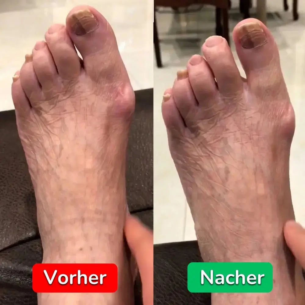 BunionFixer - Ballenzehen - Korrektor - Asipu.Deutschland